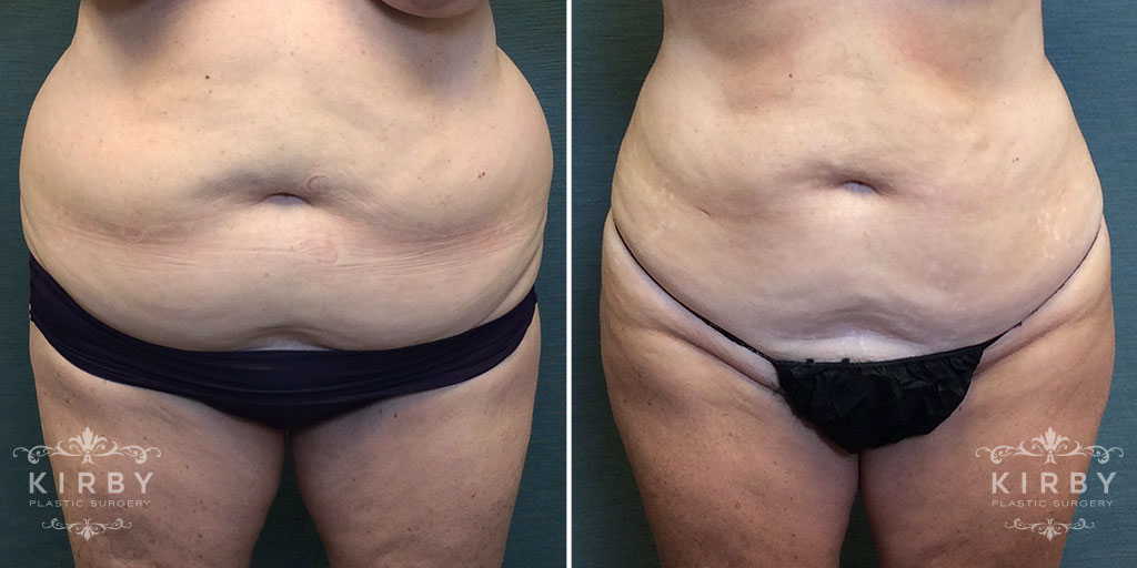 Liposuction G1304