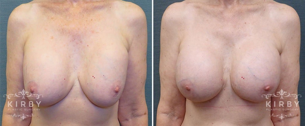 Breast Implant Exchange with Lift G1109