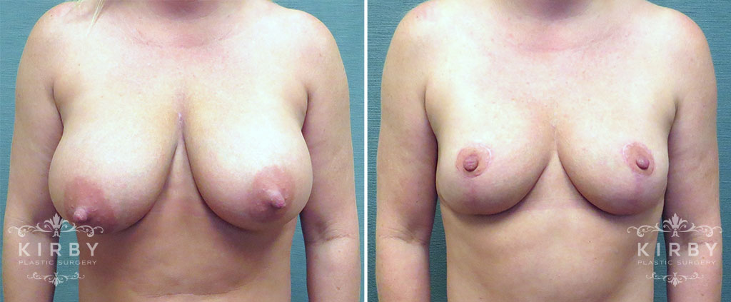 Breast Reduction G1170