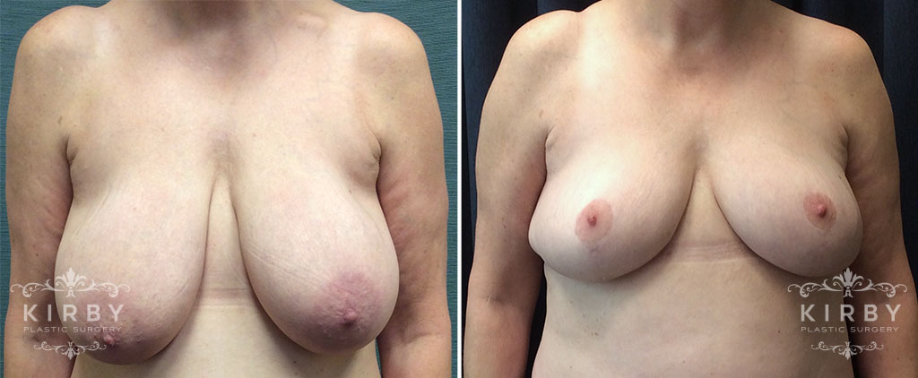 Breast Reduction G1645