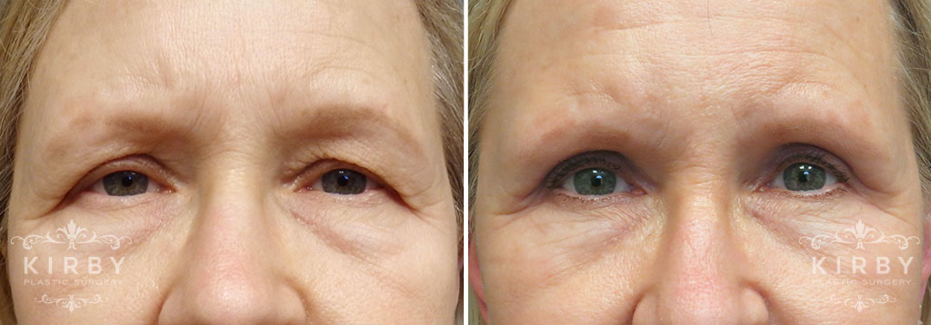 Upper Eyelid Lift G1148