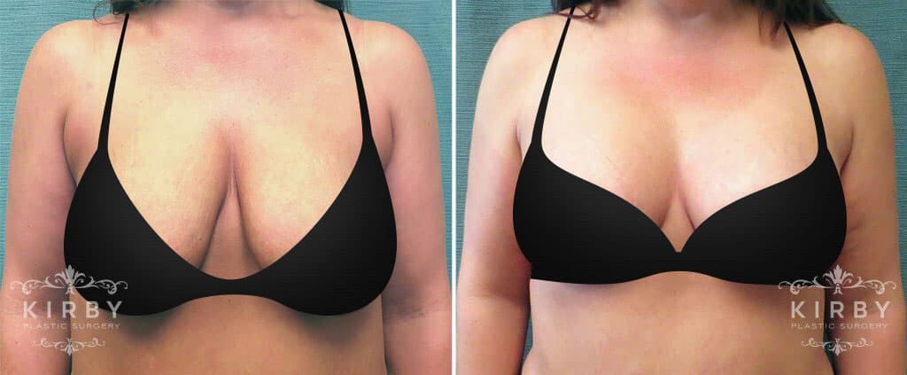 Female patient of Dr. Kirby's shown before and after breast lift with silicone breast implants