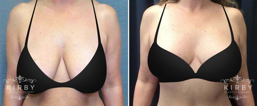 Breast lift for asymmetrical breasts - Plastic Surgeon