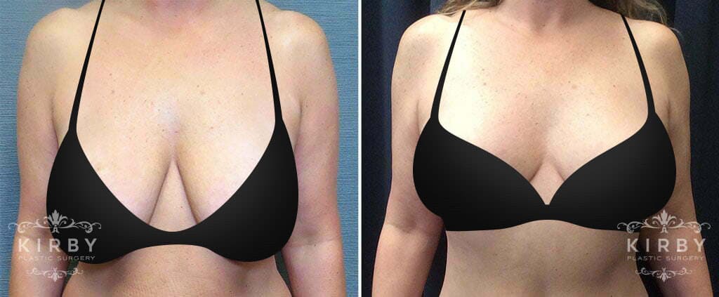 Pin on Breast lift