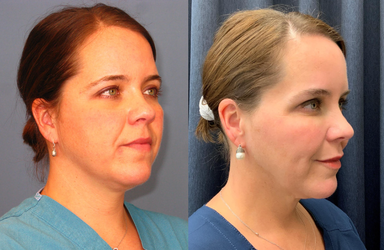 Dr. Kirby before and after consistent use of medical-grade skincare products. 