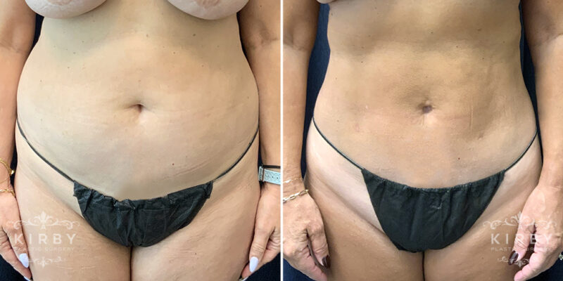 Photo of a female patient before (left) and after (right) liposuction.