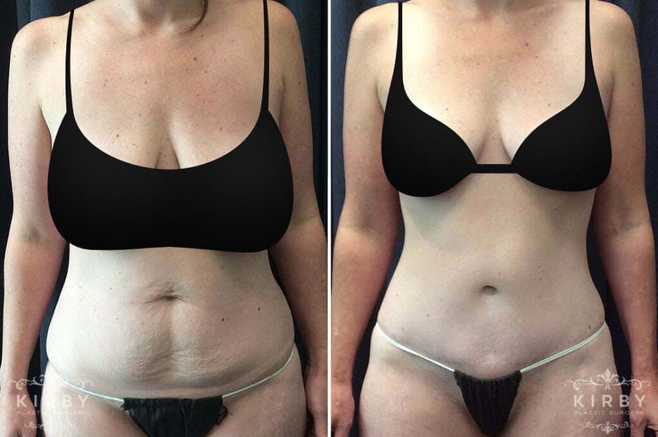 Patient image showing Dr. Kirby’s female tummy patient’s torso before and after tummy tuck plastic surgery. In the Before photo, the patient presents with some mild loose skin and fat deposits on the abdomen, obscuring her naturally slim figure. In the After photo, the patient’s abdomen has a natural-looking but slimmer and streamlined contour that is proportional with the rest of her body, with no visible scars above the bikini line. 