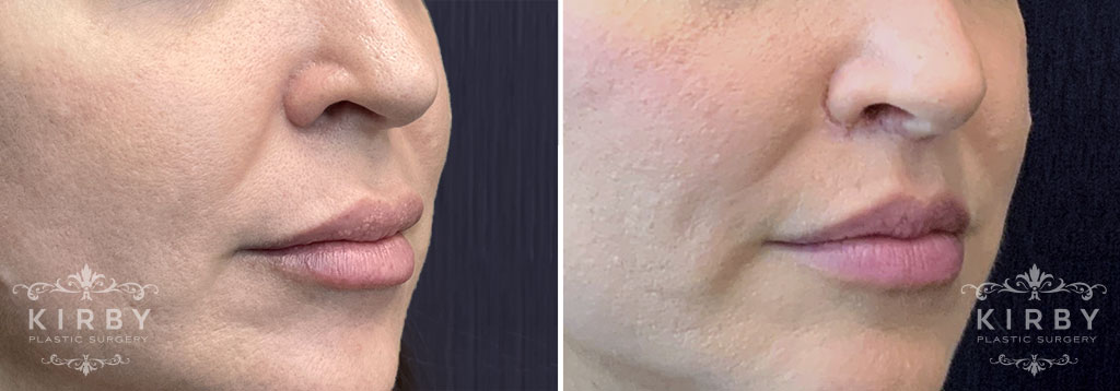 lip-lift-g1954b-kirby