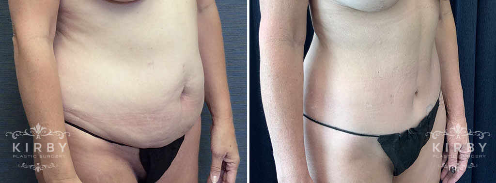 Female patient before and after a mommy makeover with tummy tuck in Fort Worth, TX. Quarter profile view.