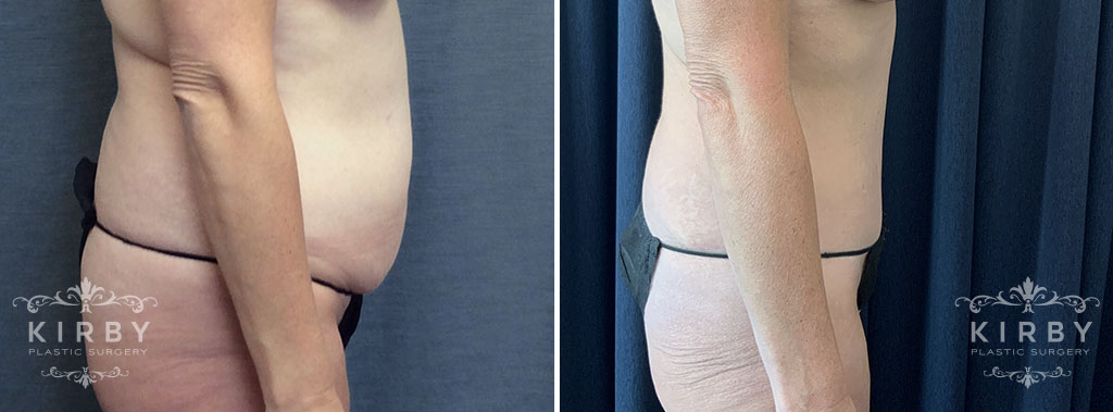 Female patient before and after a mommy makeover with tummy tuck in Fort Worth, TX. Profile view.