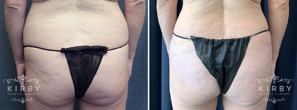 Female patient before and after a mommy makeover with tummy tuck in Fort Worth, TX. Back view.