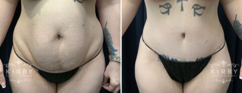 Female patient before and after a mommy makeover with tummy tuck in Fort Worth, TX. Front view.