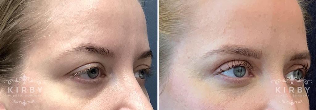 Side view of female patient before and after eyelid lift and brow lift Fort Worth
