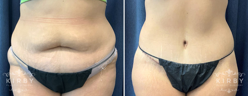 Tummy Tuck with Liposuction G1815