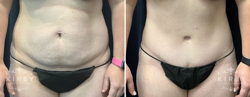 Tummy Tuck with Liposuction G1855