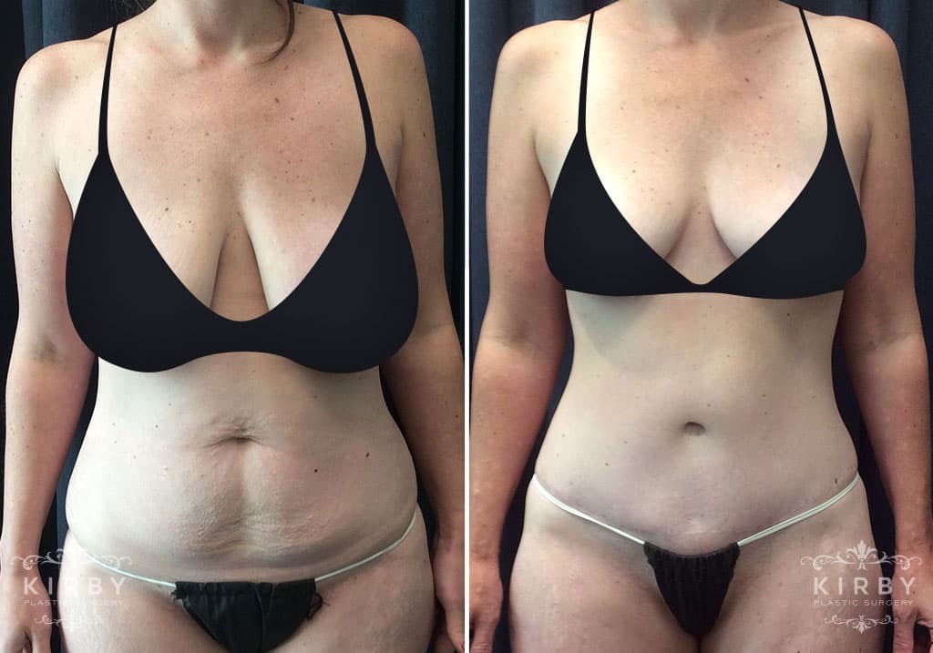 Before and after a mommy makeover in Fort worth with female plastic surgeon Dr. Emily Kirby