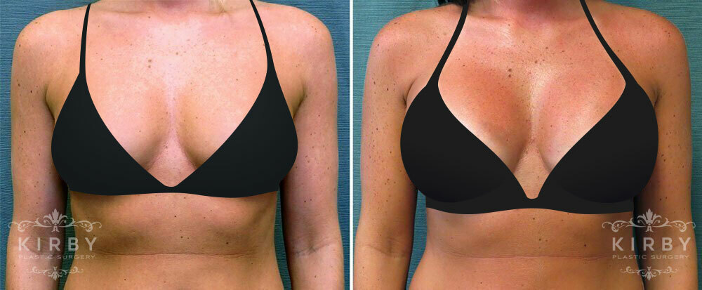Before and after Fort Worth breast augmentation with plastic surgeon Dr. Emily J. Kirby