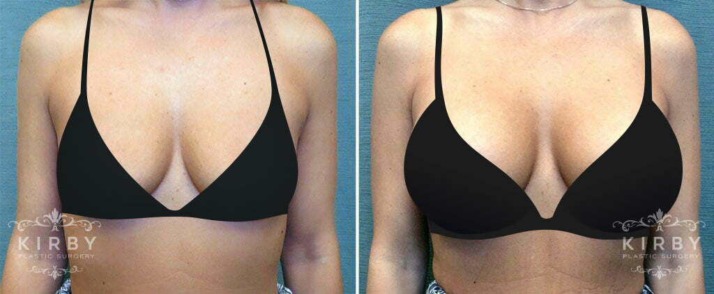 Before and after breast augmentation in Fort Worth with female plastic surgeon Dr. Emily J. Kirby