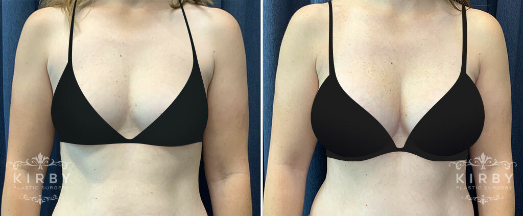 Before and after breast augmentation Fort Worth with top plastic surgeon Dr. Emily J. Kirby