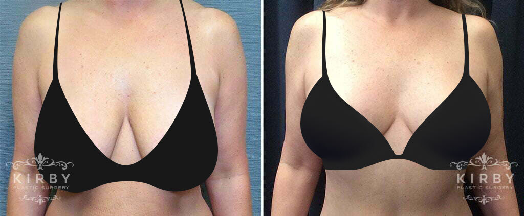 Before and after mommy makeover with breast lift in Fort Worth with Dr. Kirby