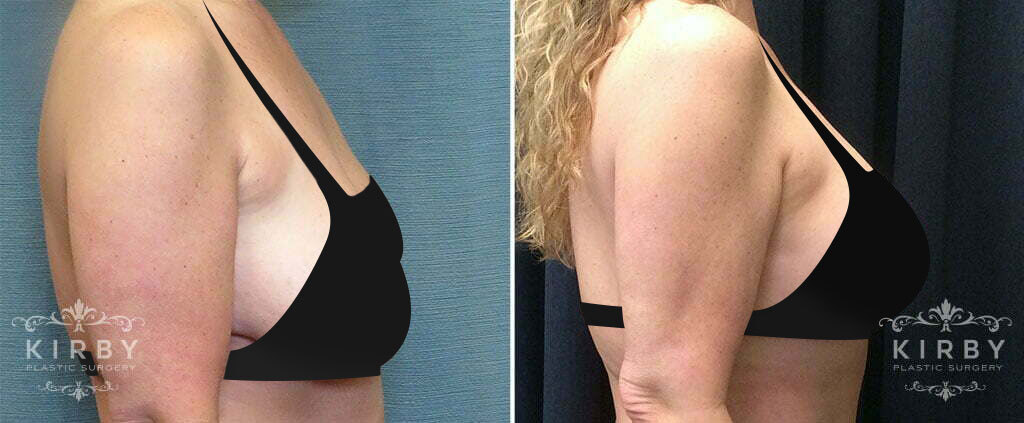 Before and after mommy makeover with breast lift in Fort Worth with Dr. Kirby