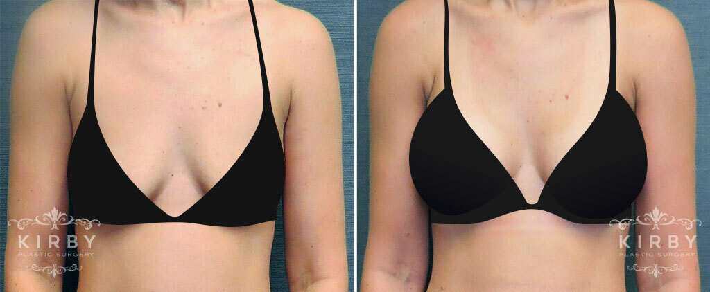 Before and after Fort Worth breast augmentation with Dr. Emily Kirby 