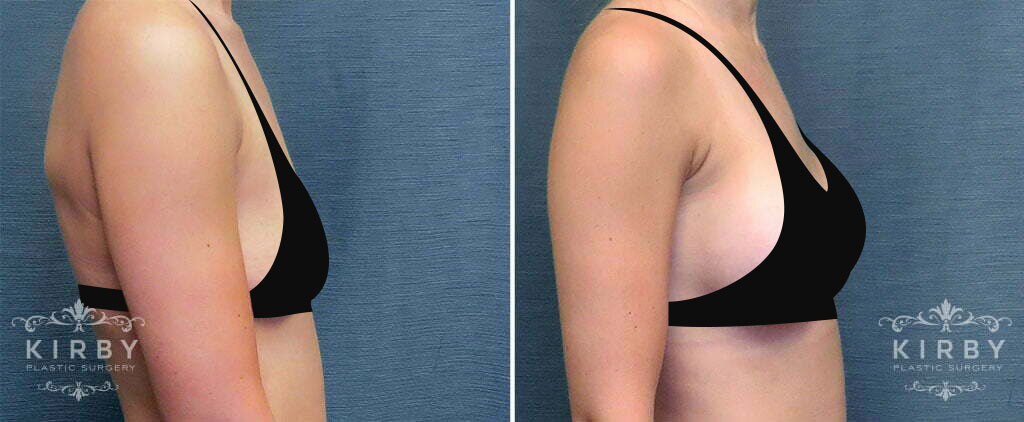 Before and after Fort Worth breast augmentation with Dr. Emily Kirby 