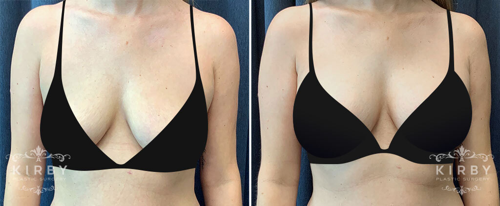 Before and after Fort Worth breast lift with implants with Dr. Emily Kirby 