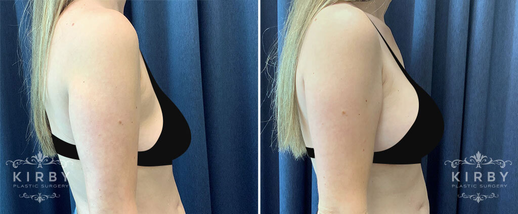 Before and after Fort Worth breast lift with implants with Dr. Emily Kirby 